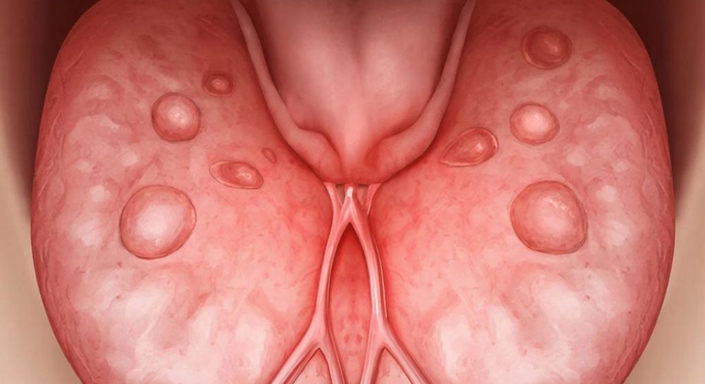 Эффективное лечение гранулезного фарингита в домашних условиях для взрослых