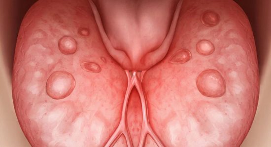 Эффективное лечение гранулезного фарингита в домашних условиях для взрослых